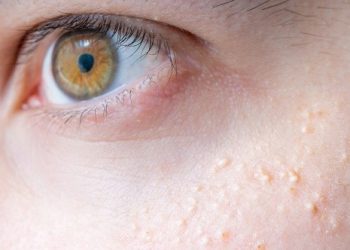 lẩy mụn thịt nhỏ dưới mí mắt