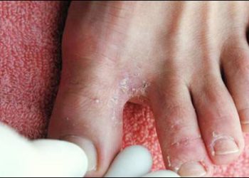 Xử trí khi bị nấm da chân ngày mưa