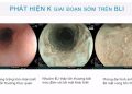 Ứng dụng trí tuệ nhân tạo trong nội soi tiêu hóa giúp nhận biết sớm ung thư