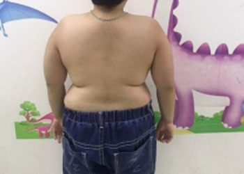 Trẻ mắc Hội chứng Cushing do lạm dụng thuốc chống viêm.