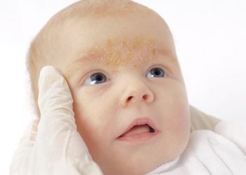 Trẻ em bị khô da