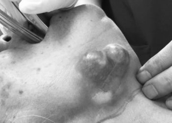 Khối ung thư tuyến nước bọt dưới hàm xâm lấn rất rộng.