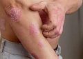 Bệnh vẩy nến gây ngứa, khó chịu cho người bệnh.
