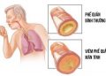 Ho là triệu chứng thường gặp trong bệnh viêm phế quản.