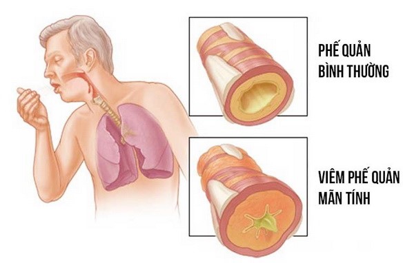 Ho là triệu chứng thường gặp trong bệnh viêm phế quản.