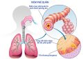 Linh chi lợi phế hỗ trợ điều trị bệnh đường hô hấp, viêm khí phế quản